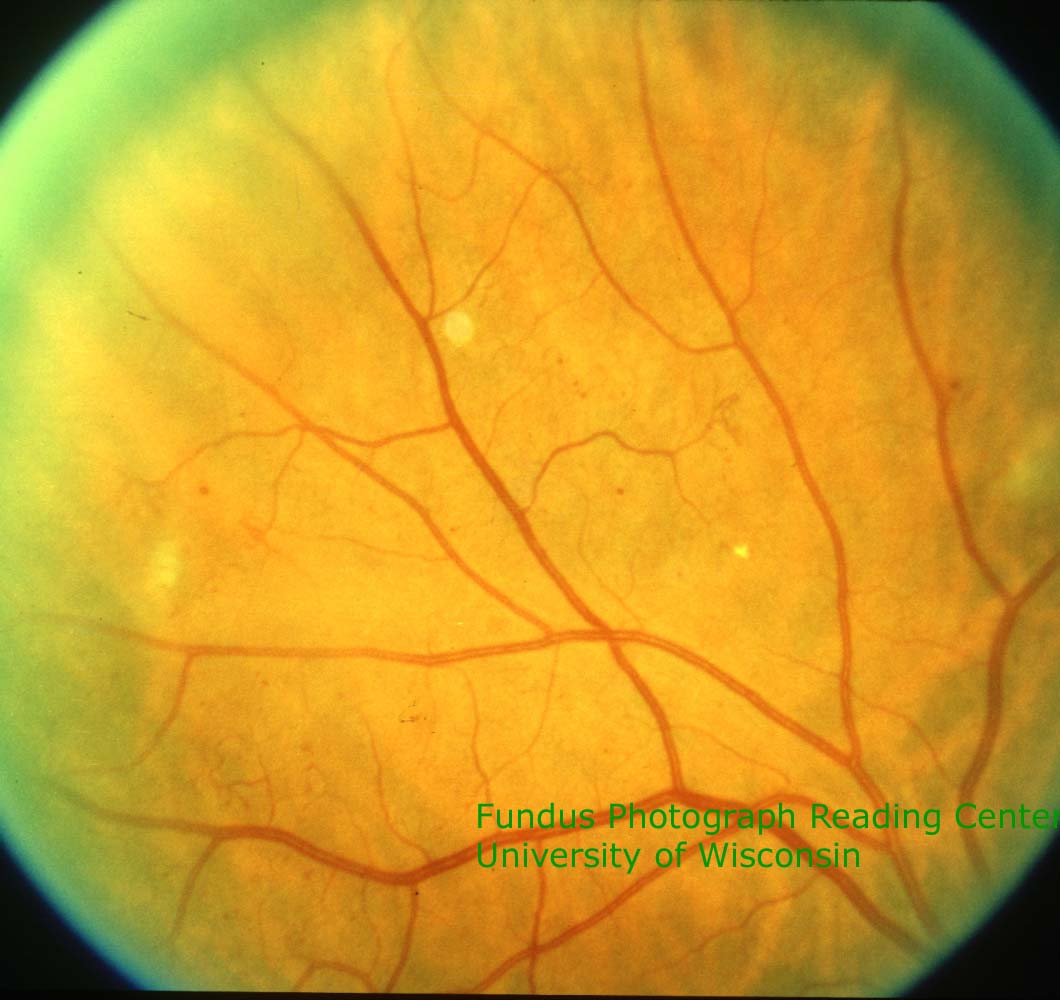 Eyepacs Digital Retinal Image Grading